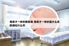 像痱子一样的银屑病 像痱子一样的是什么皮肤病吃什么药