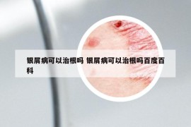 银屑病可以治根吗 银屑病可以治根吗百度百科