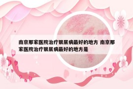 南京那家医院治疗银屑病最好的地方 南京那家医院治疗银屑病最好的地方是