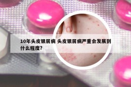 10年头皮银屑病 头皮银屑病严重会发展到什么程度?