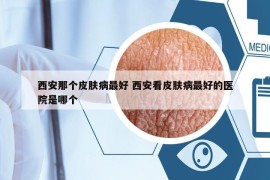 西安那个皮肤病最好 西安看皮肤病最好的医院是哪个