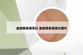 面部银屑病发红 面部银屑病发红图片