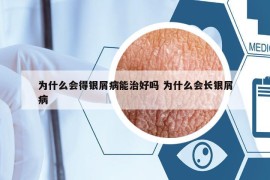 为什么会得银屑病能治好吗 为什么会长银屑病