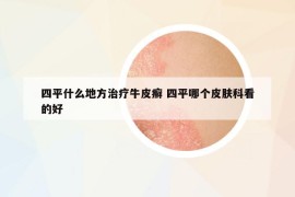 四平什么地方治疗牛皮癣 四平哪个皮肤科看的好