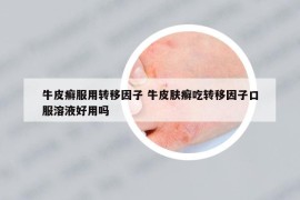 牛皮癣服用转移因子 牛皮肤癣吃转移因子口服溶液好用吗