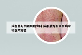 成都最好的银屑病专科 成都最好的银屑病专科医院排名