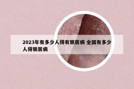 2023年有多少人得有银屑病 全国有多少人得银屑病