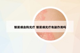 银屑病自购光疗 银屑病光疗有副作用吗