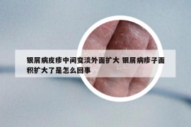 银屑病皮疹中间变淡外面扩大 银屑病疹子面积扩大了是怎么回事