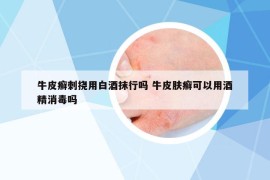 牛皮癣刺挠用白酒抹行吗 牛皮肤癣可以用酒精消毒吗