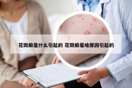 花斑癣是什么引起的 花斑癣是啥原因引起的