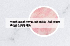点滴状银屑病吃什么药效果最好 点滴状银屑病吃什么药好得快