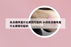 白点癫风是什么原因引起的 小孩白点癫风是什么原因引起的