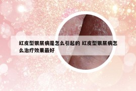 红皮型银屑病是怎么引起的 红皮型银屑病怎么治疗效果最好