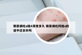 银屑病吃a维A得用多久 银屑病吃阿维a的途中还会长吗