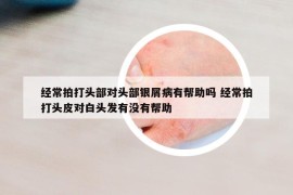 经常拍打头部对头部银屑病有帮助吗 经常拍打头皮对白头发有没有帮助