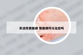 农泊性银翘病 银翘病可以治愈吗