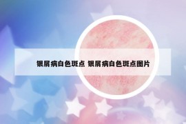 银屑病白色斑点 银屑病白色斑点图片