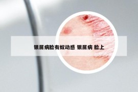 银屑病脸有蚁动感 银屑病 脸上
