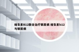 维生素B12联合治疗银屑病 维生素b12与银屑病