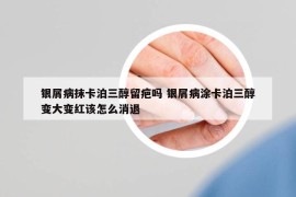 银屑病抹卡泊三醇留疤吗 银屑病涂卡泊三醇变大变红该怎么消退