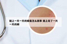 腿上一片一片的癣是怎么回事 腿上出了一片一片的癣