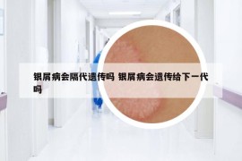 银屑病会隔代遗传吗 银屑病会遗传给下一代吗
