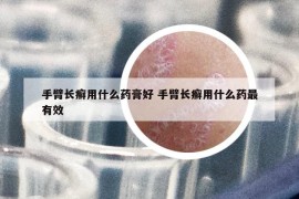 手臂长癣用什么药膏好 手臂长癣用什么药最有效