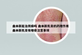 曲米新能治阴癣吗 曲米新乳膏的药理作用 曲米新乳膏有哪些注意事项