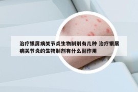 治疗银屑病关节炎生物制剂有几种 治疗银屑病关节炎的生物制剂有什么副作用