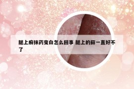 腿上癣抹药变白怎么回事 腿上的藓一直好不了