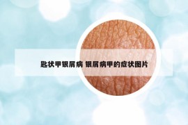 匙状甲银屑病 银屑病甲的症状图片
