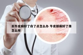 长牛皮癣好了白了点怎么办 牛皮肤癣好了像怎么样