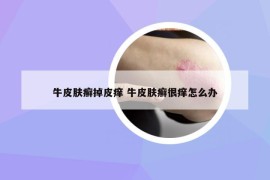 牛皮肤癣掉皮痒 牛皮肤癣很痒怎么办