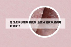 急性点滴状银屑病脱屑 急性点滴状银屑病开始蜕皮了