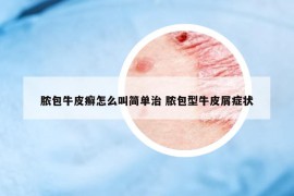 脓包牛皮癣怎么叫简单治 脓包型牛皮屑症状
