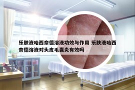 乐肤液哈西奈德溶液功效与作用 乐肤液哈西奈德溶液对头皮毛囊炎有效吗