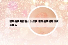 银屑癣初期都有什么症状 银屑病的初期症状是什么