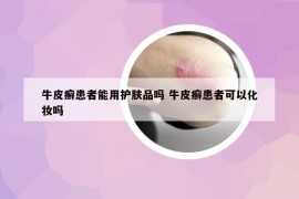 牛皮癣患者能用护肤品吗 牛皮癣患者可以化妆吗