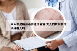 大人牛皮癣会不会遗传宝宝 大人的皮癣会传染给婴儿吗