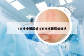 5岁宝宝银屑病 5岁宝宝银屑病症状