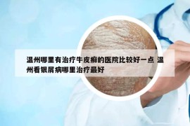 温州哪里有治疗牛皮癣的医院比较好一点 温州看银屑病哪里治疗最好