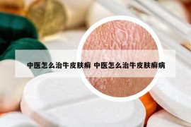 中医怎么治牛皮肤癣 中医怎么治牛皮肤癣病