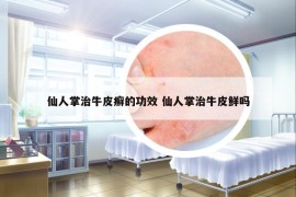 仙人掌治牛皮癣的功效 仙人掌治牛皮鲜吗