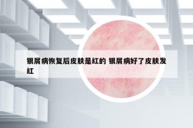 银屑病恢复后皮肤是红的 银屑病好了皮肤发红