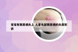 宝宝有银屑病头上 儿童头部银屑病的头屑形状