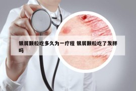 银屑颗粒吃多久为一疗程 银屑颗粒吃了发胖吗