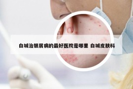 白城治银屑病的最好医院是哪里 白城皮肤科