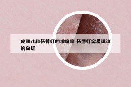 皮肤ct和伍德灯的准确率 伍德灯容易误诊的白斑