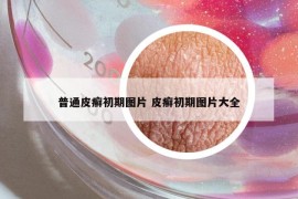 普通皮癣初期图片 皮癣初期图片大全